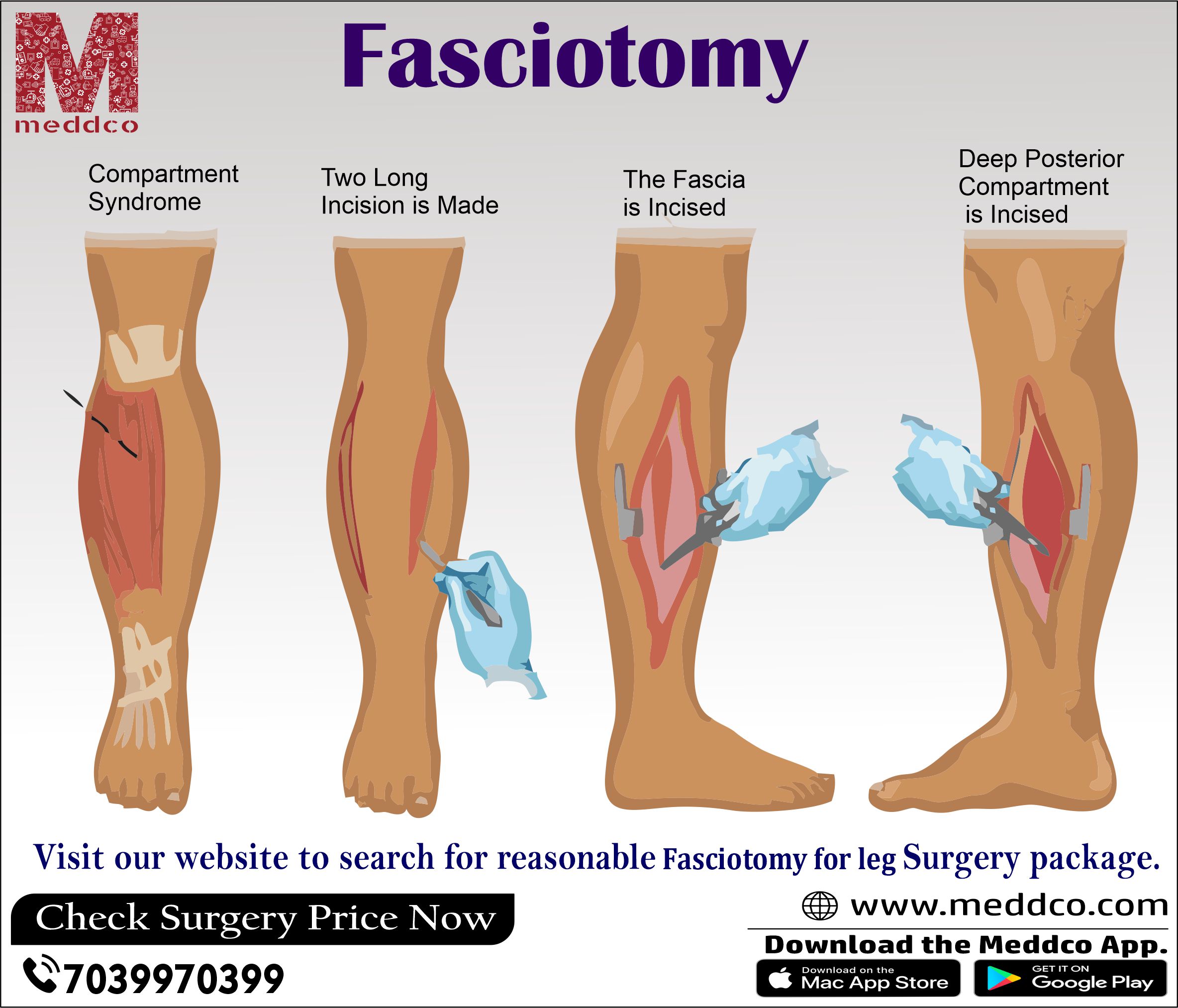 Longitudinal Fasciotomy To Decompress Dorsal Interosseous Muscles The
