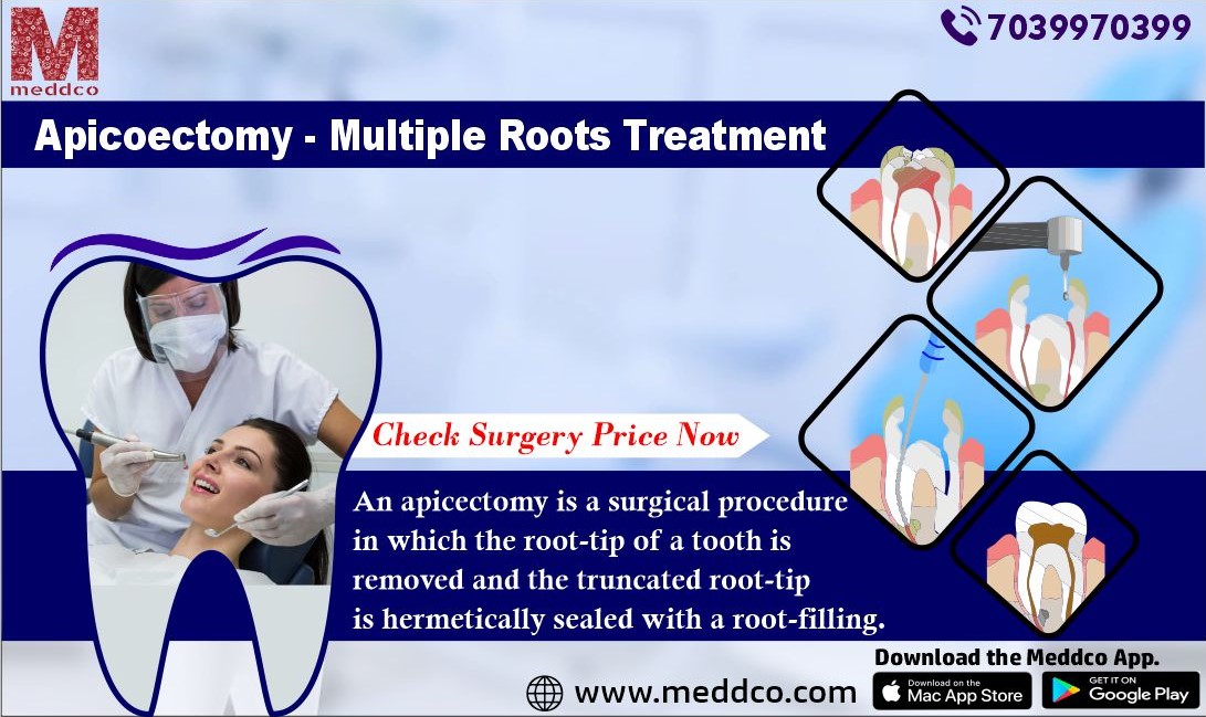 articles/Apicoectomy_-_Multiple_Roots_Treatment.jpg