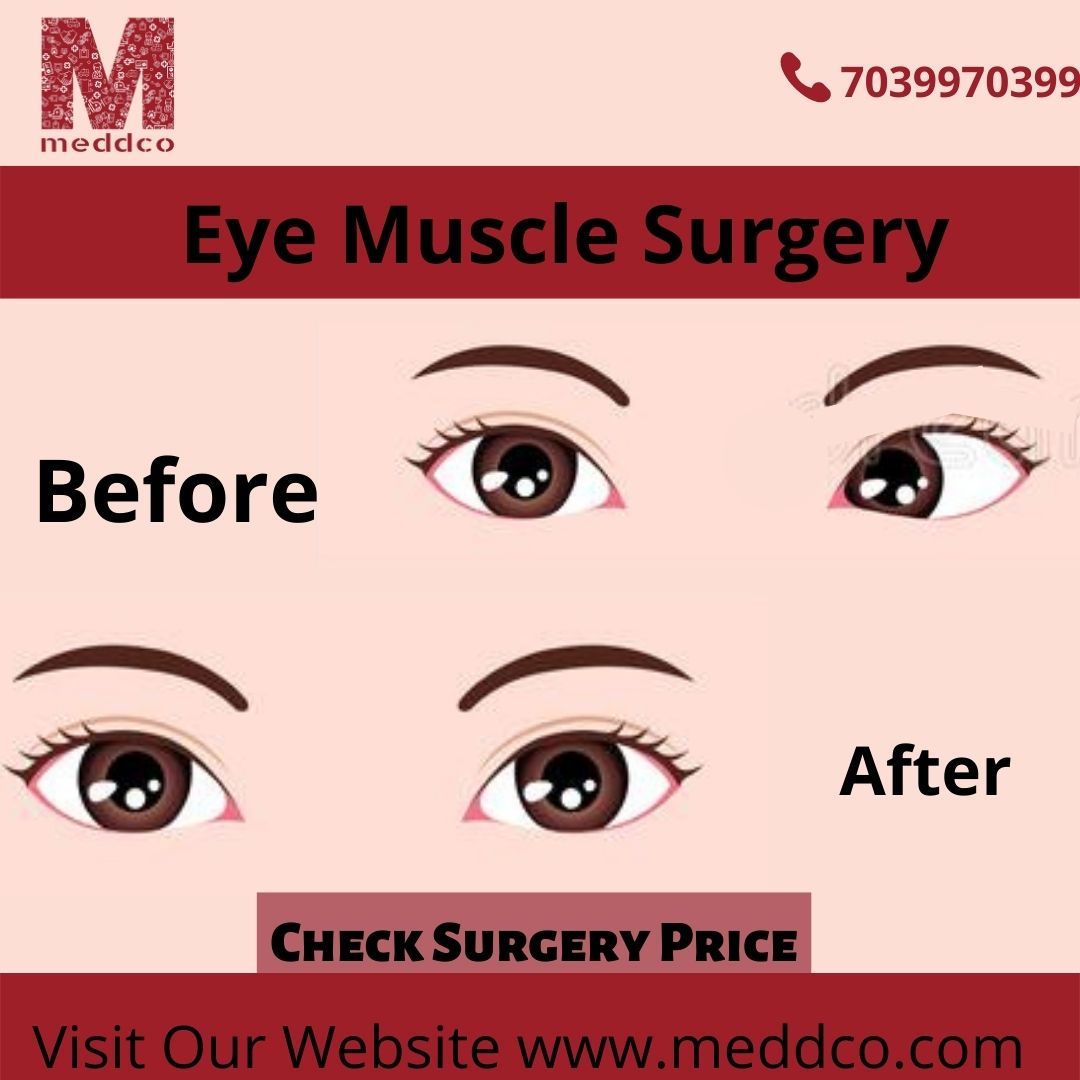 What Is the Purpose of Eye Muscle Surgery?