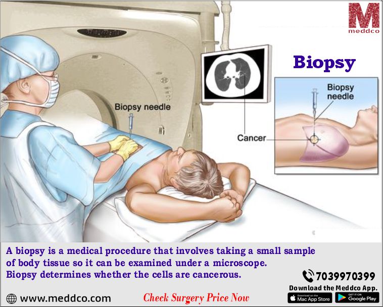 Everything you need to know about Biopsy