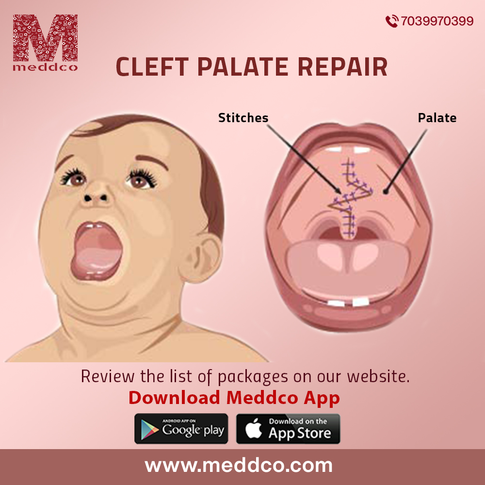 An informative blog on Cleft Repair