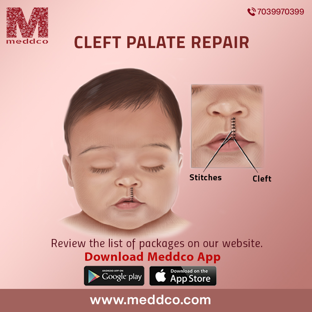 What is the treatment for cleft palate.