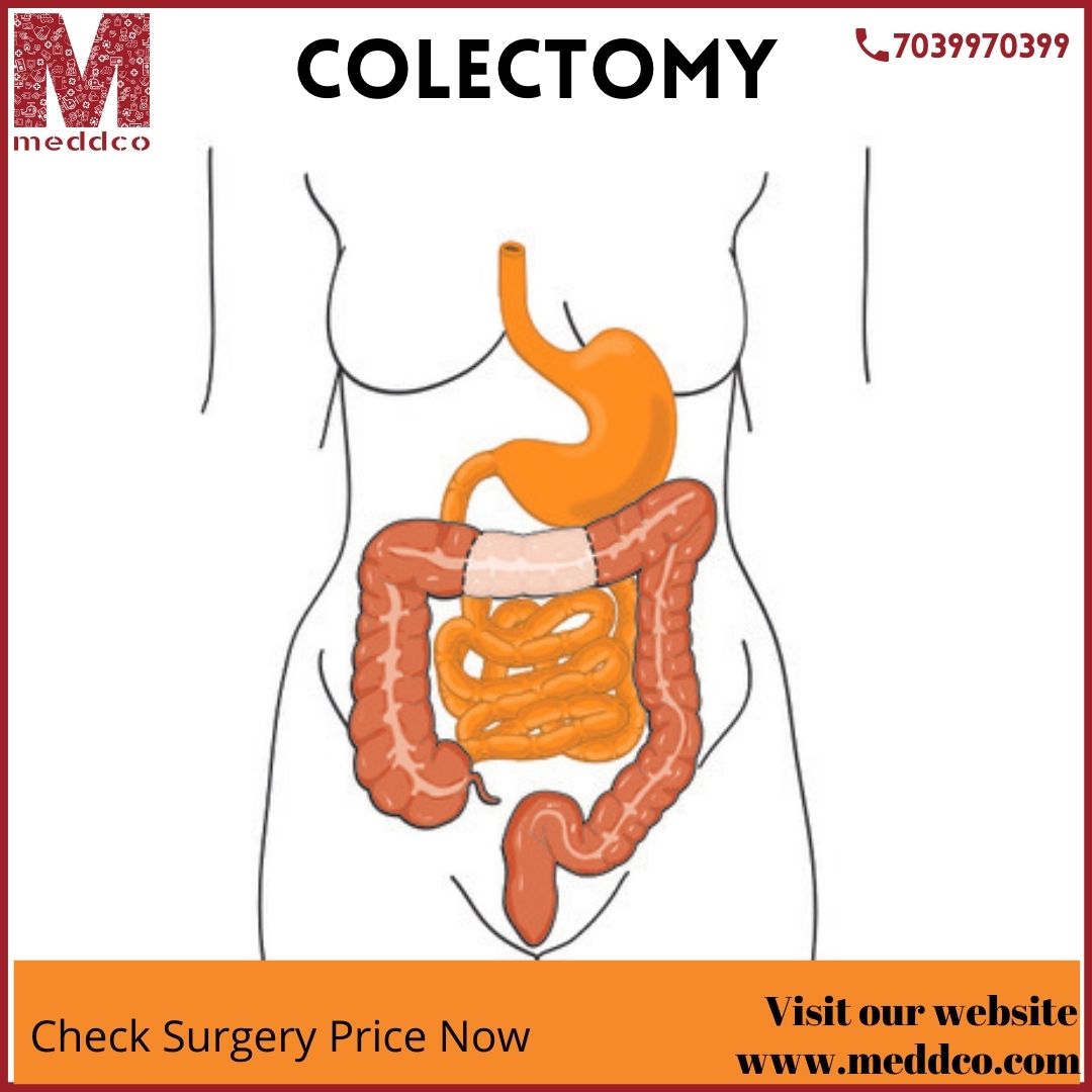 All you should know about Colectomy
