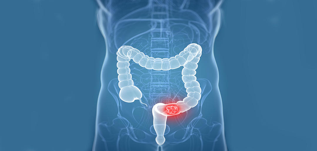 What is Colon Cancer? Can It Be Treated?