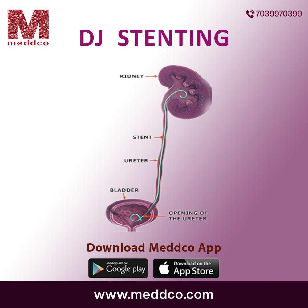 What is the purpose to clamp or attach a DJ STENT?