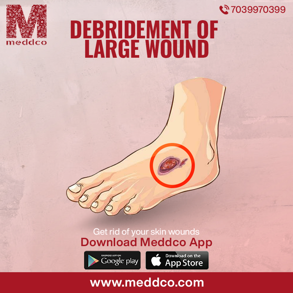 HOW CAN DEBRIDEMENT OF LARGE WOUNDS BE TREATED