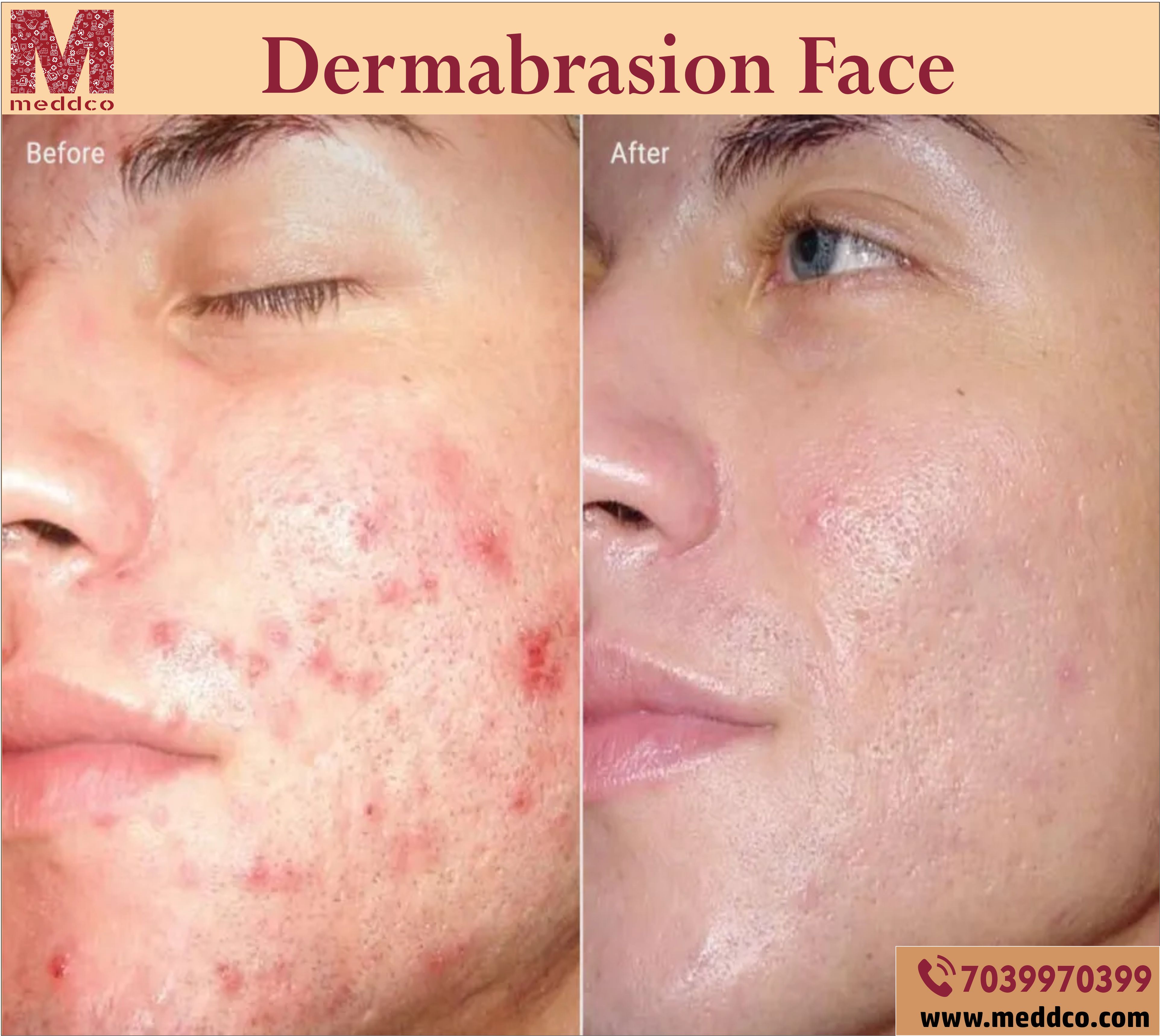 How often should you Dermabrasion your face?