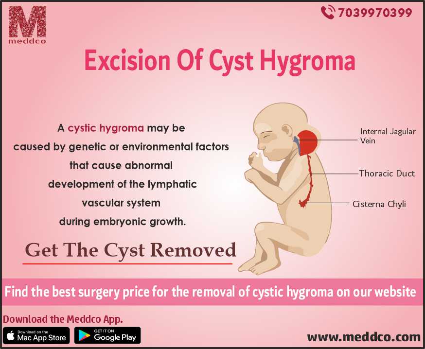 An Overview of Cystic Hygroma