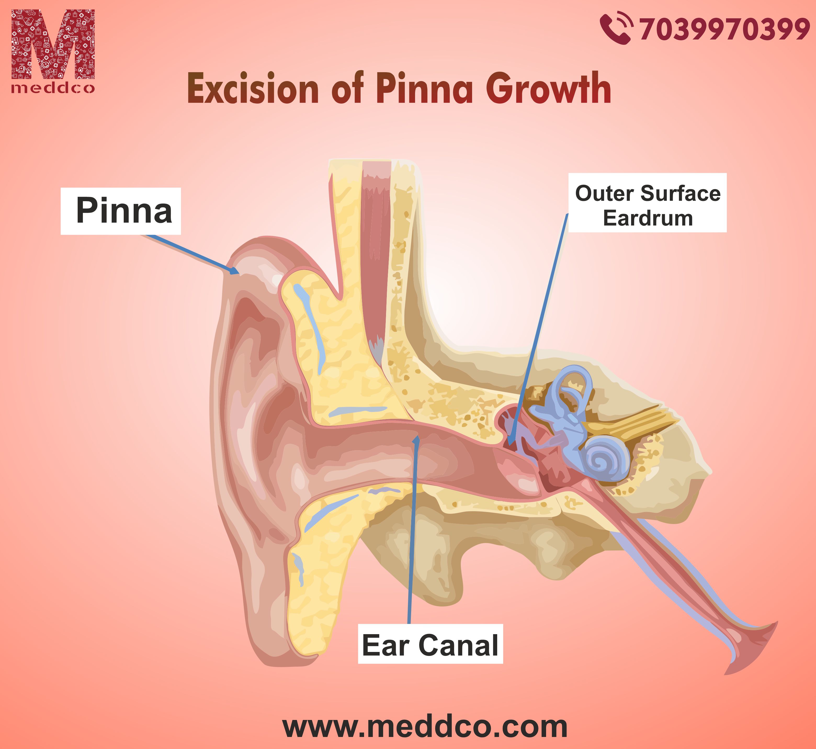 articles/Excision_of_Pinna_Growth_2.jpg