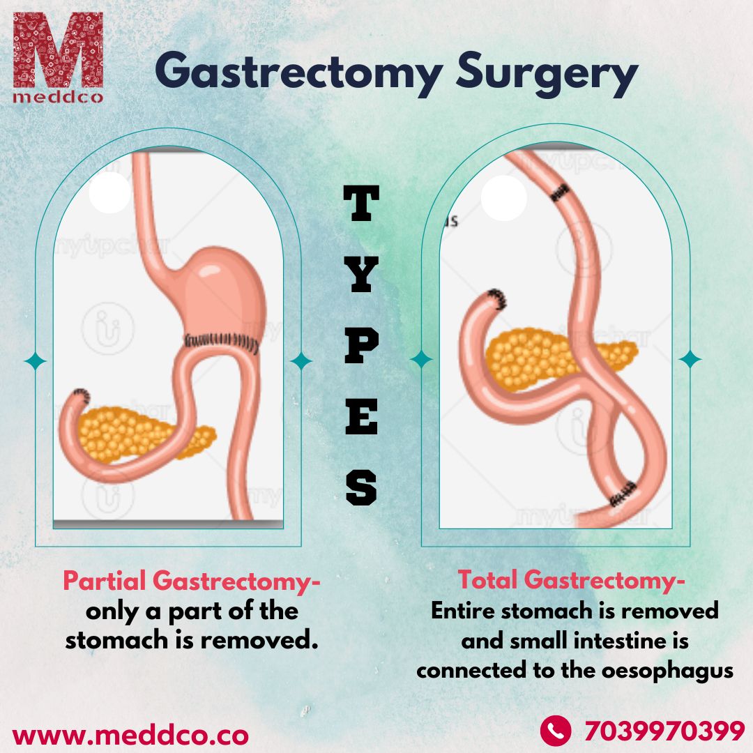 Overview of Stomach Total Gastrectomy