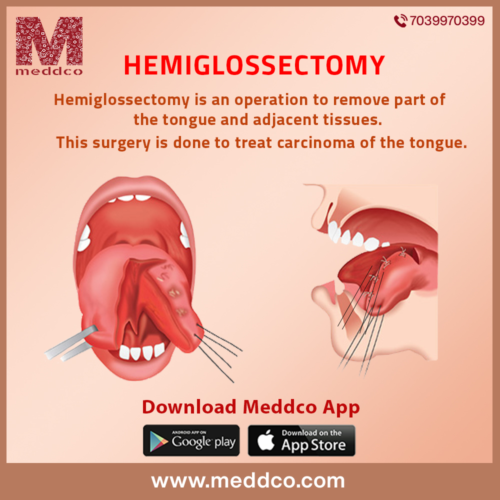 articles/Hemiglossectomy_image.jpg