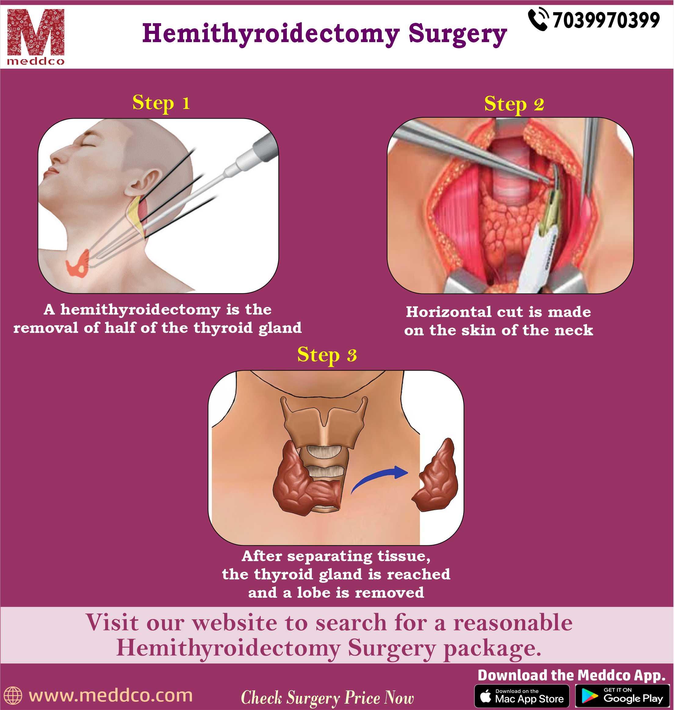 articles/Hemithyroidectomy_Surgery.jpg