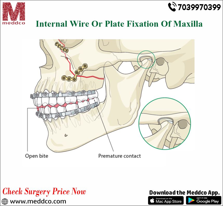 Internal wire or plate fixate​​​​​​​ion of Maxilla - A Valuable Method