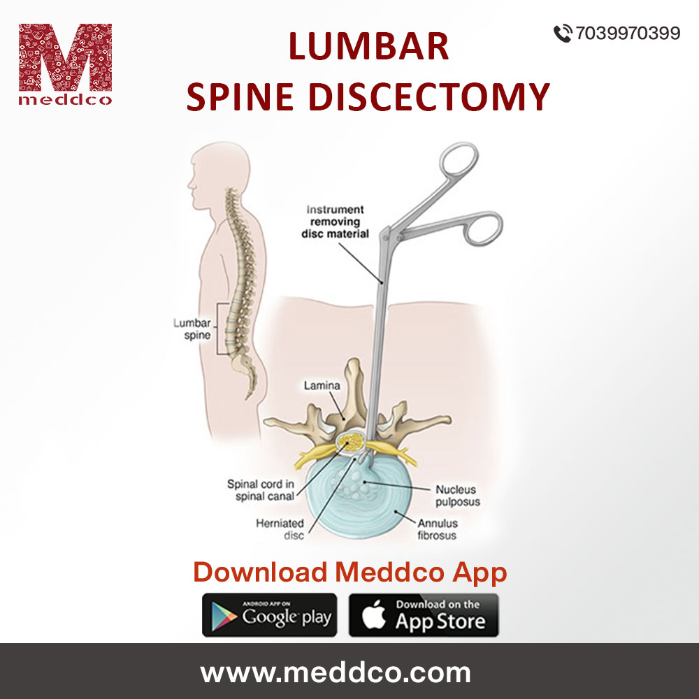 articles/LUMBAR_SPINE_DISCECTOMY.jpg