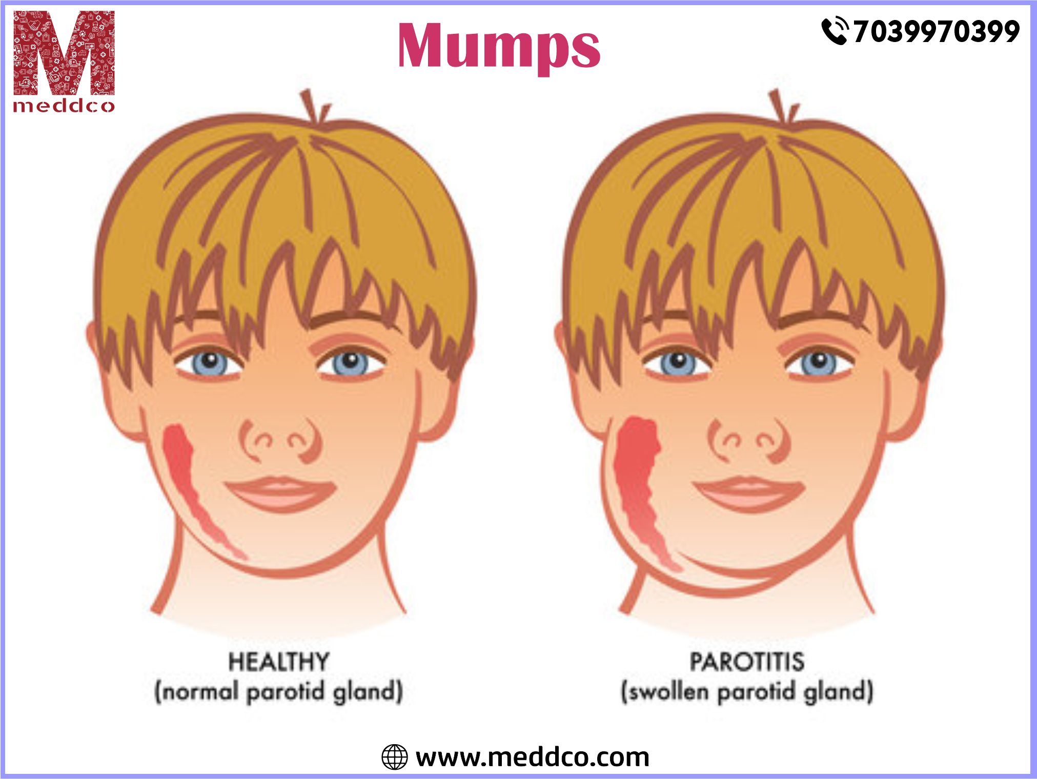 All The Vital Understanding About Mumps