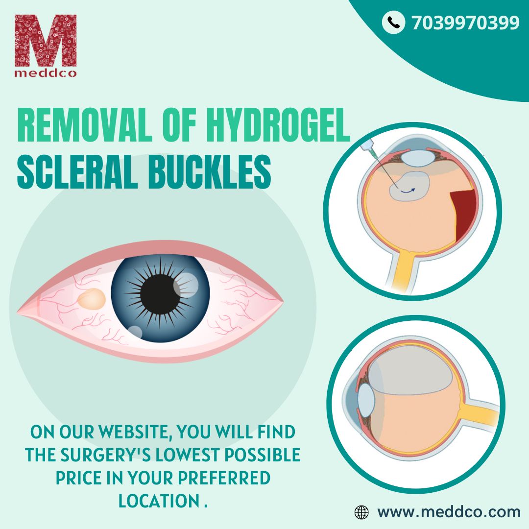 Removal of hydrogel scleral buckles.