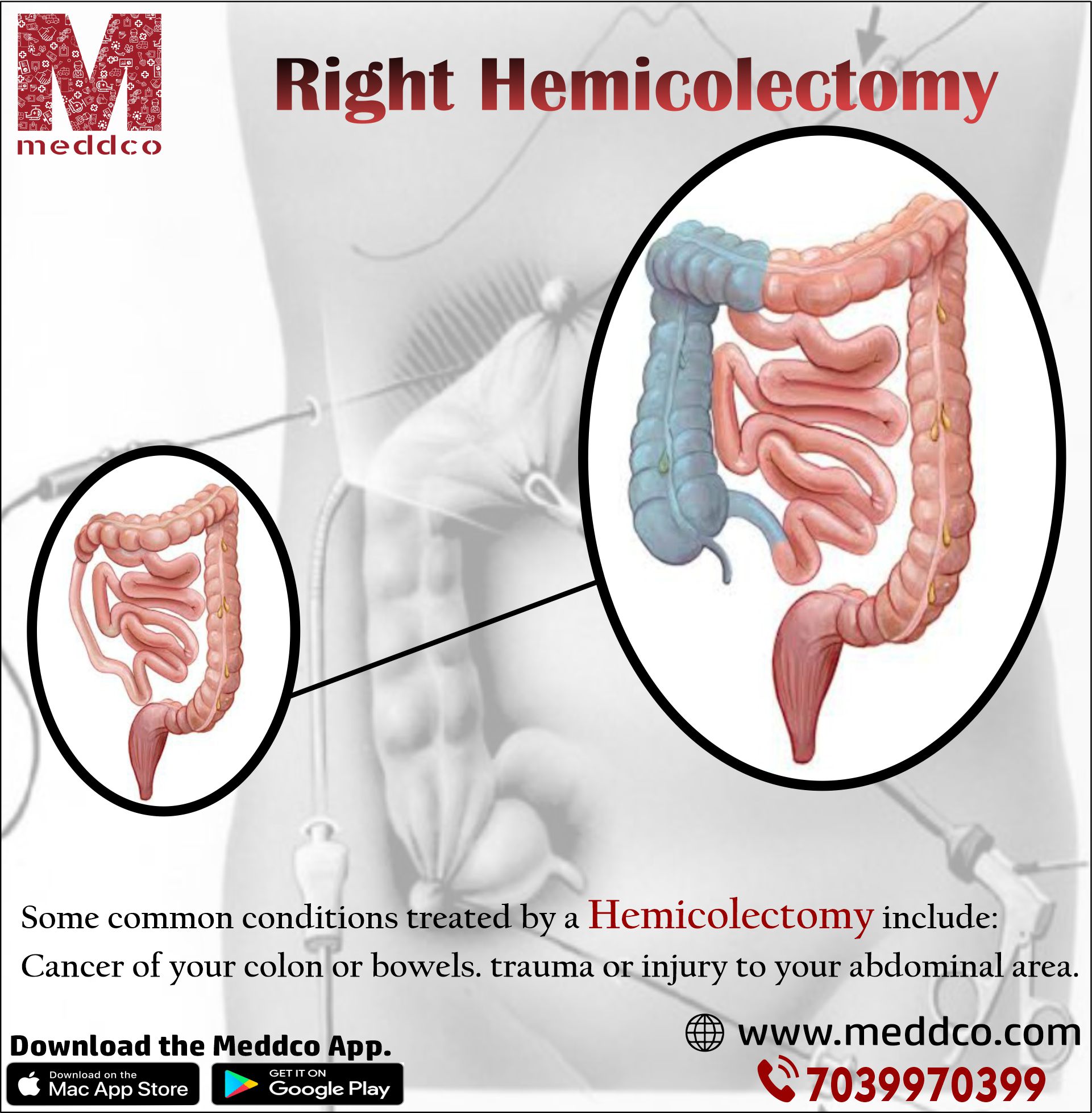 Why right hemicolectomy is done?