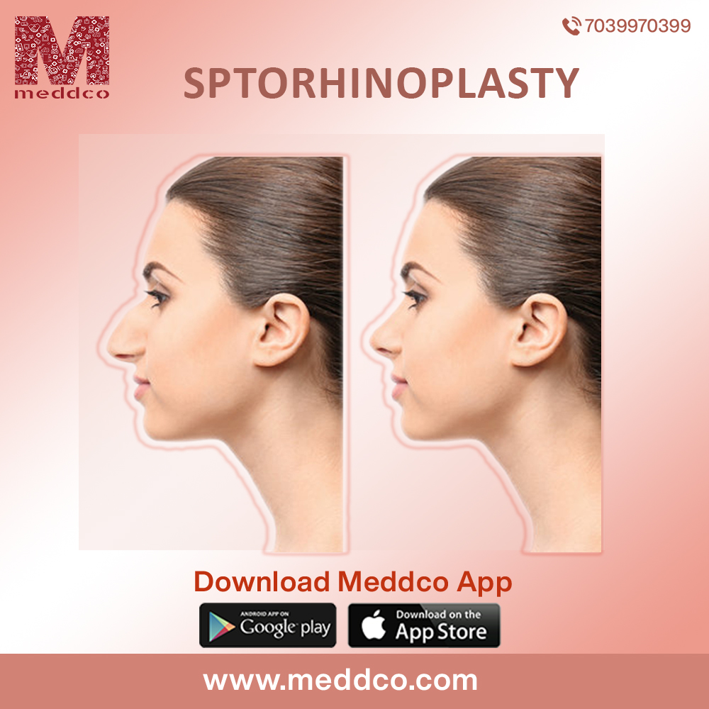 articles/Sptorhinoplasty.jpg