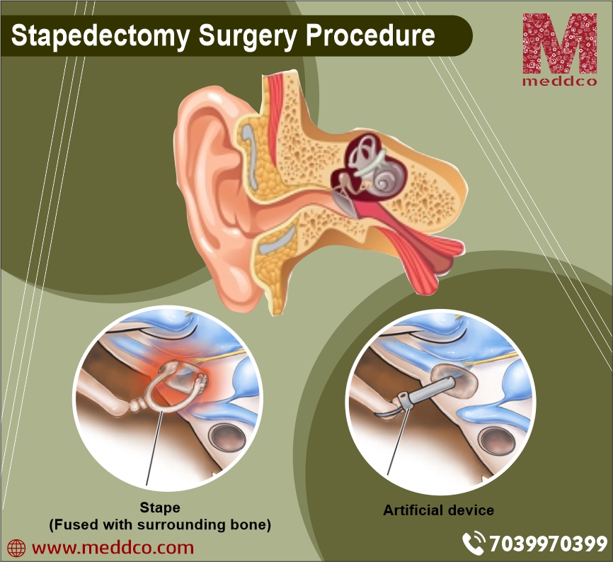 Stapedectomy Surgery for Otosclerosis - Ear Doctor Los Angeles, CA