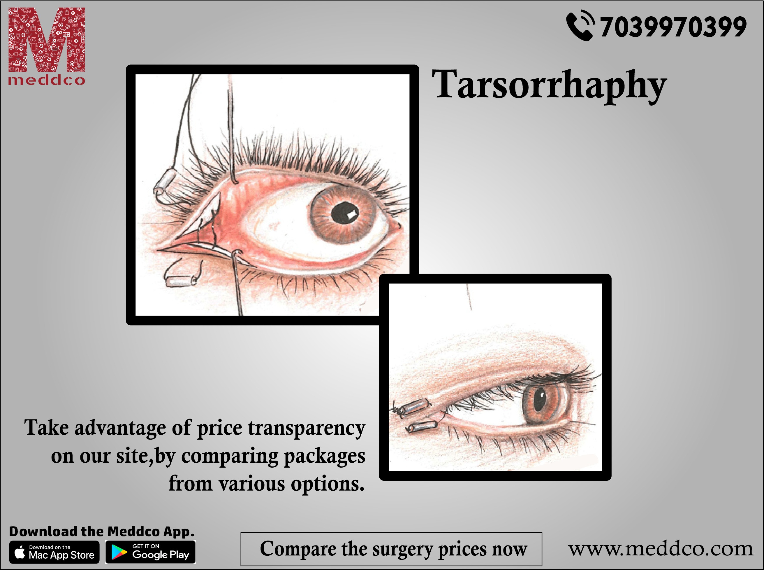 Everything you need to know about Tarsorrhaphy.