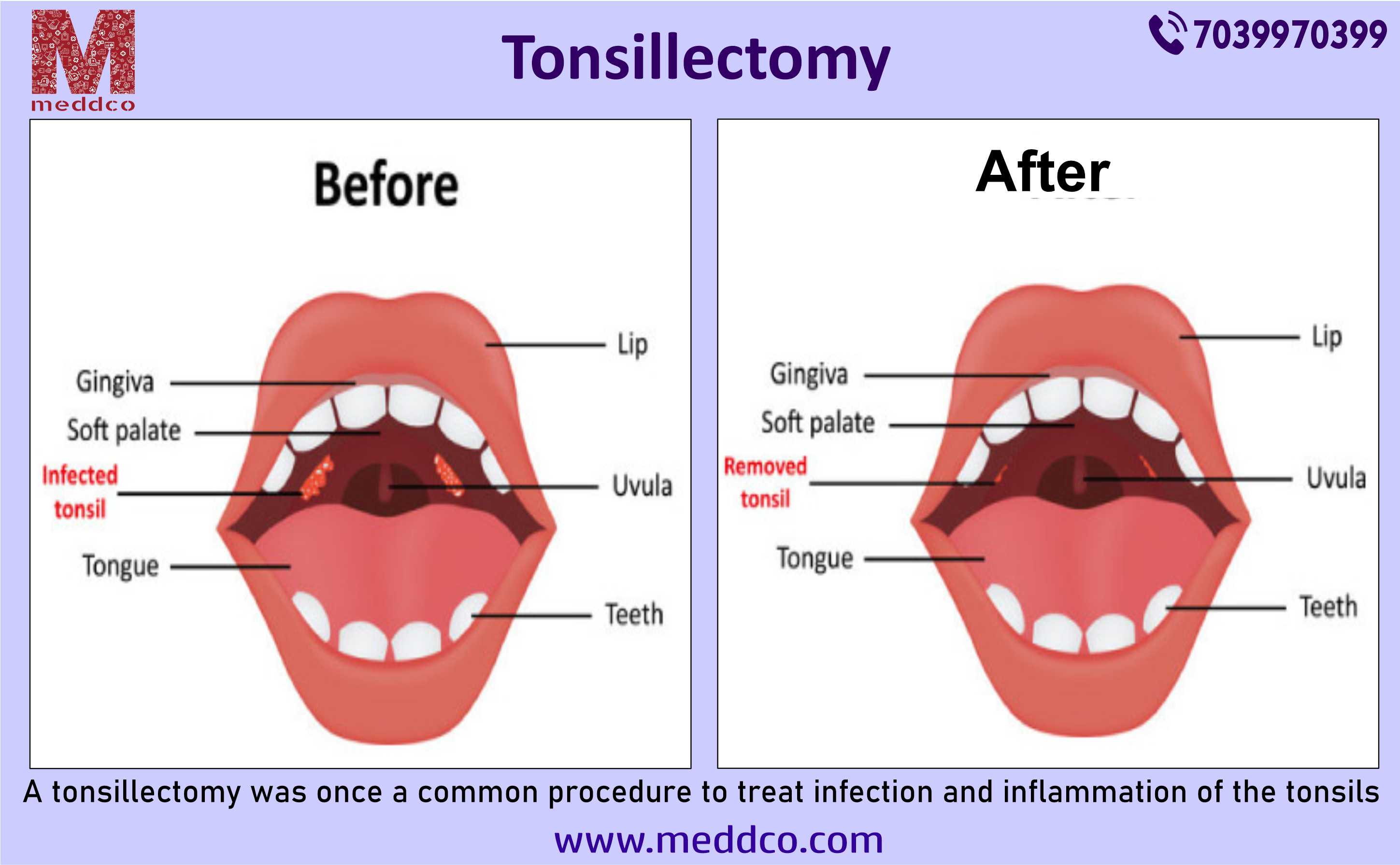 Why Getting Tonsillectomy Surgery Is Important 