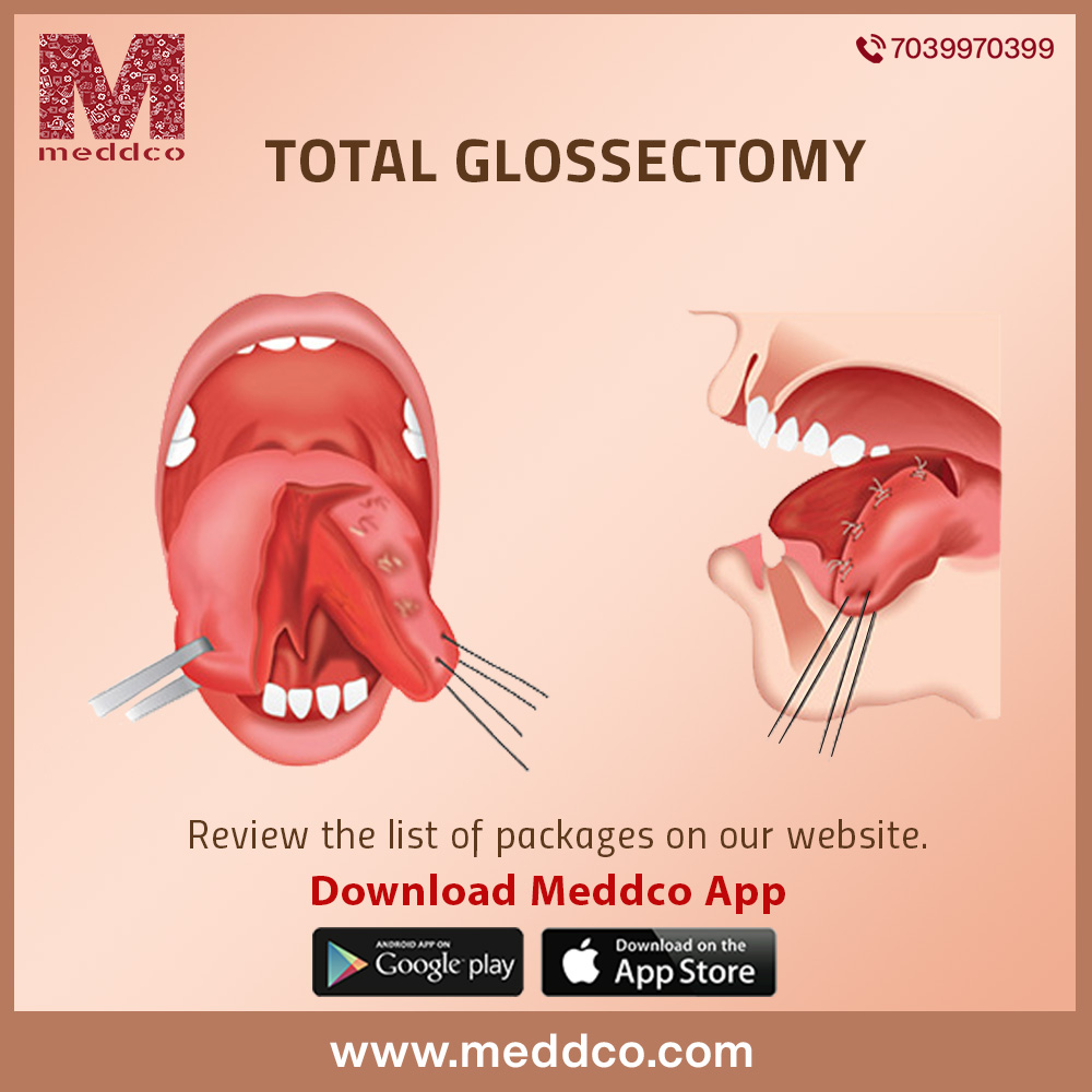 articles/Total_Glossectomy_image_3.jpg