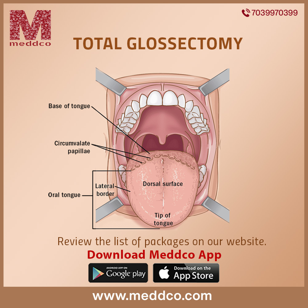 articles/Total_Glossectomy_image_4.jpg