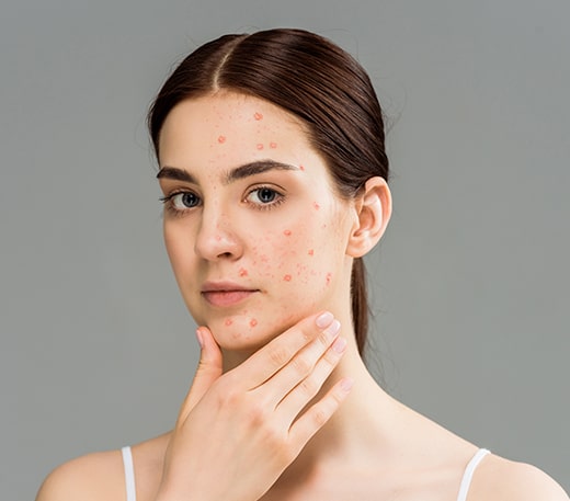 articles/Treatments-Face-Acne-meddco.jpg