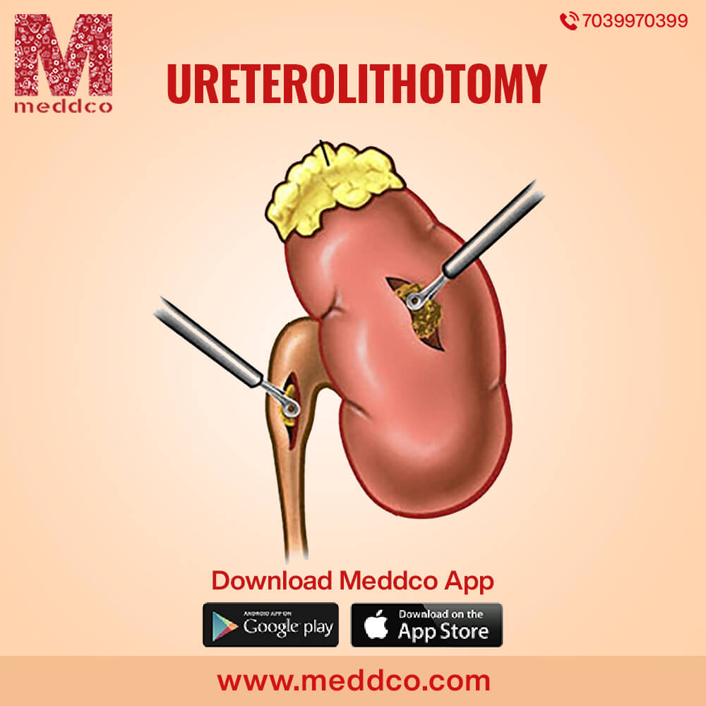 articles/Ureterolithotomy_1.jpg