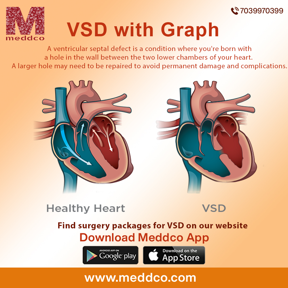 How to Diagnose VSD?