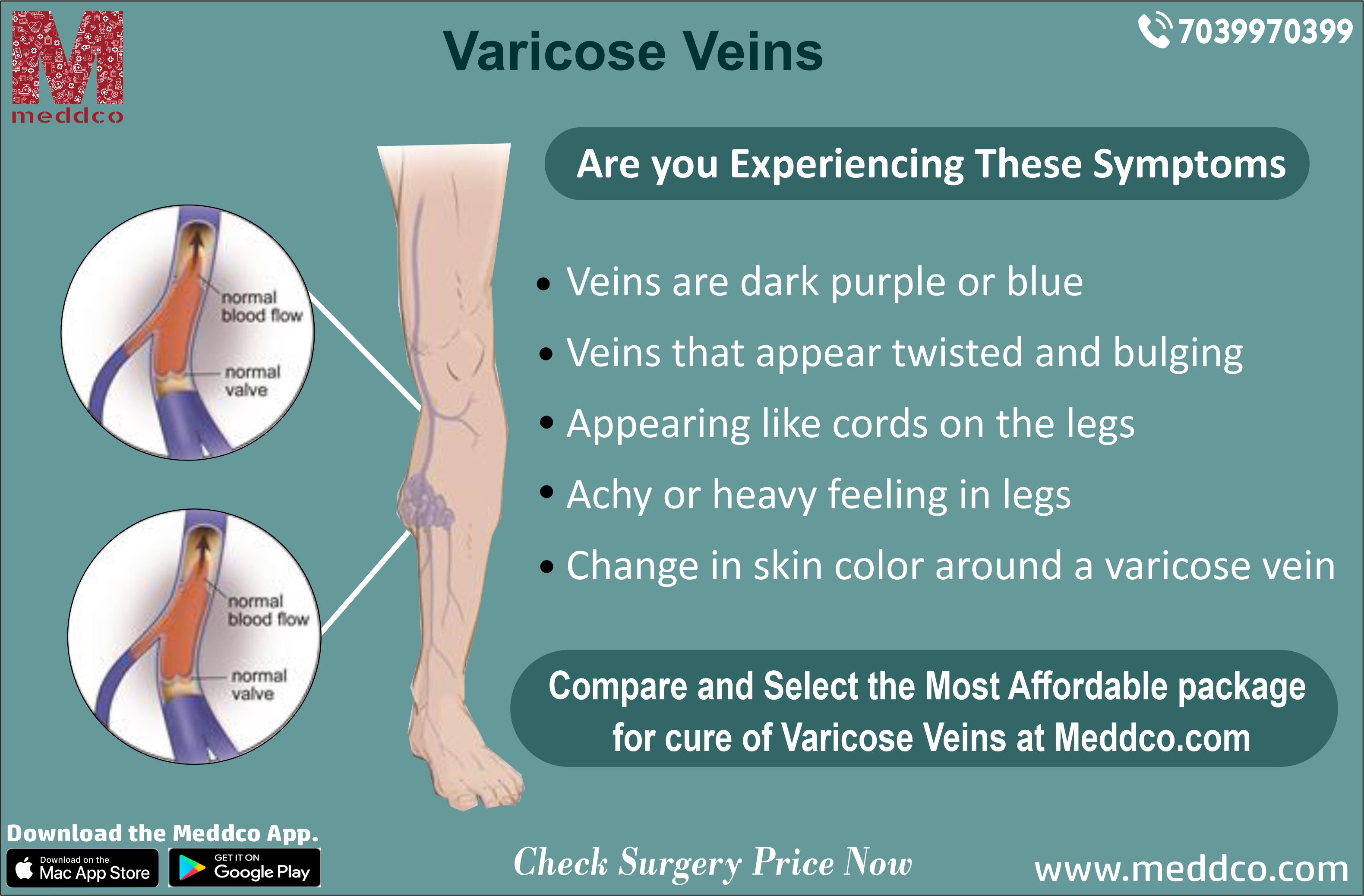 Varicose Veins – What You Need To Know