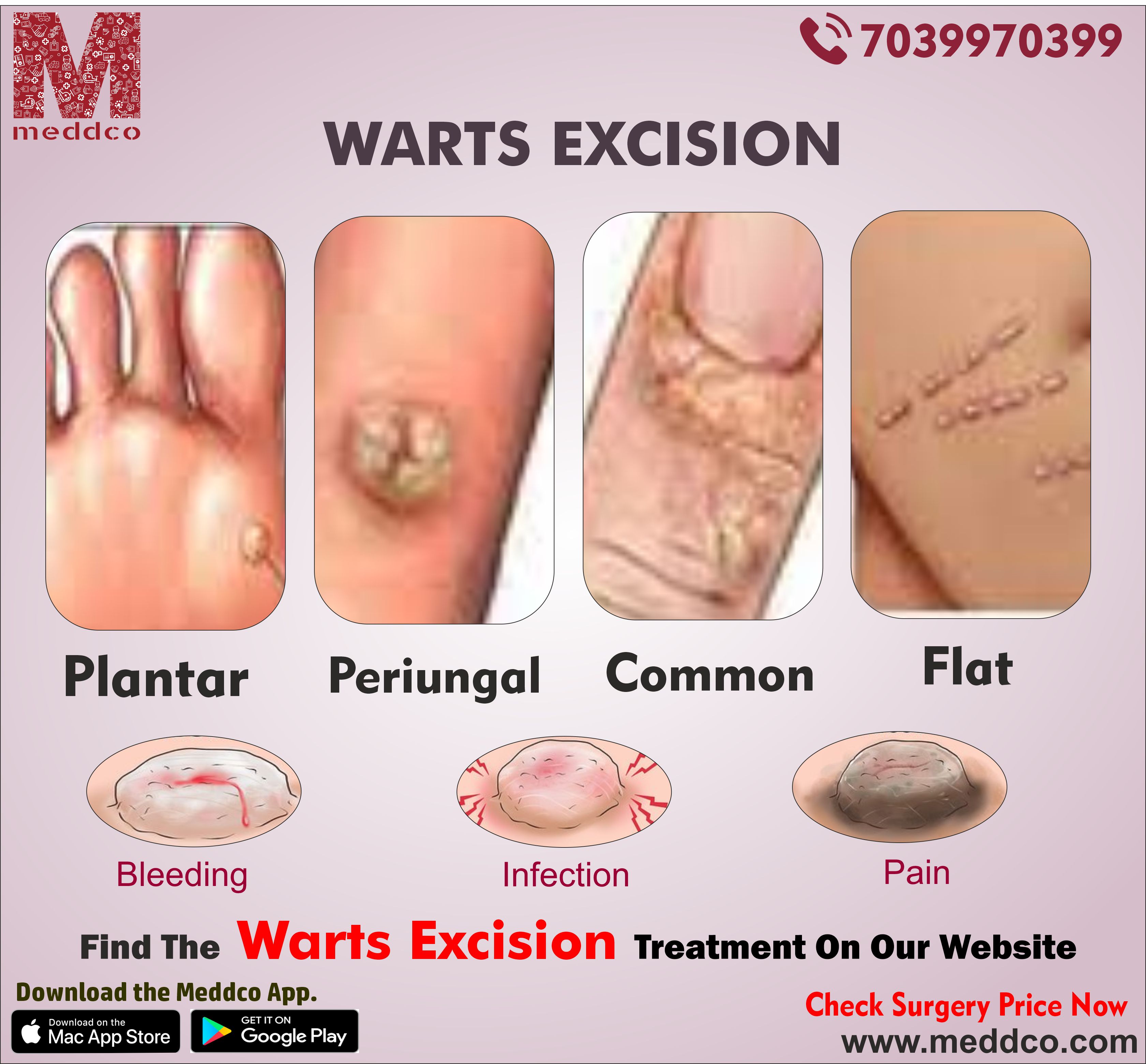 articles/WARTS_EXCISION.jpg