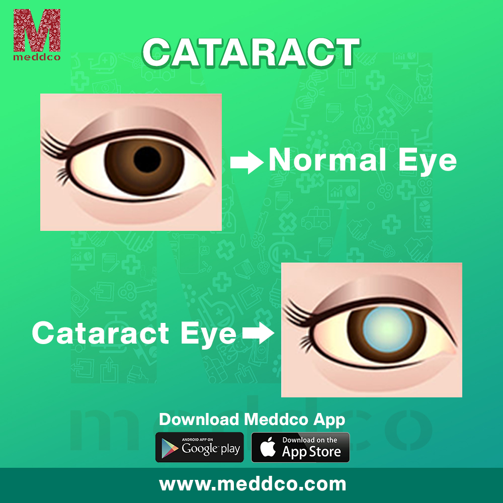 articles/cataract_2.jpg