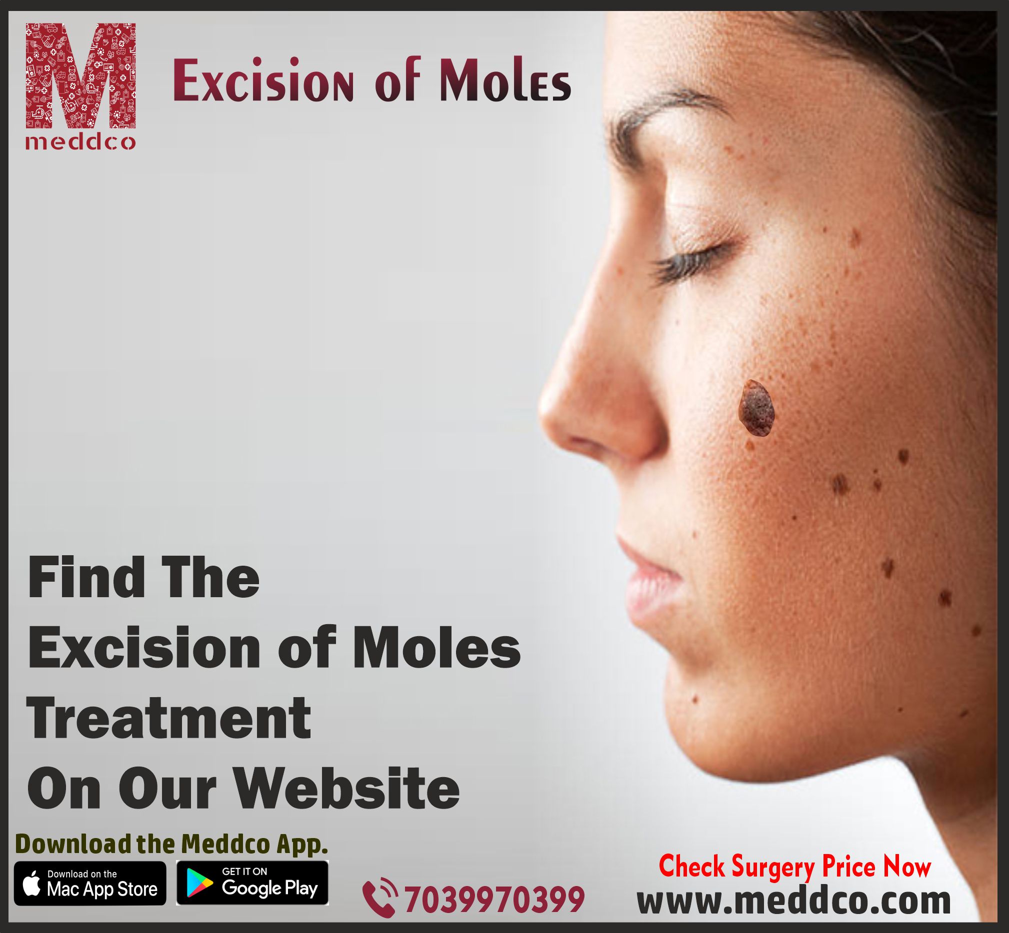 articles/excision_of_moles.jpg