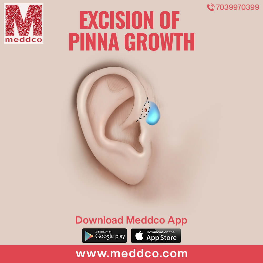 articles/excision_of_pinna_growth_1.jpg