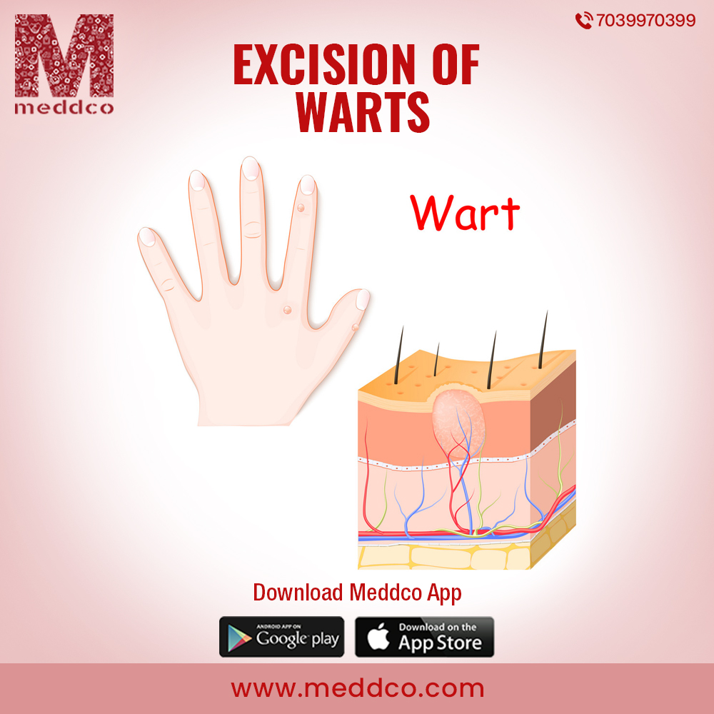 articles/excision_of_warts_1.jpg