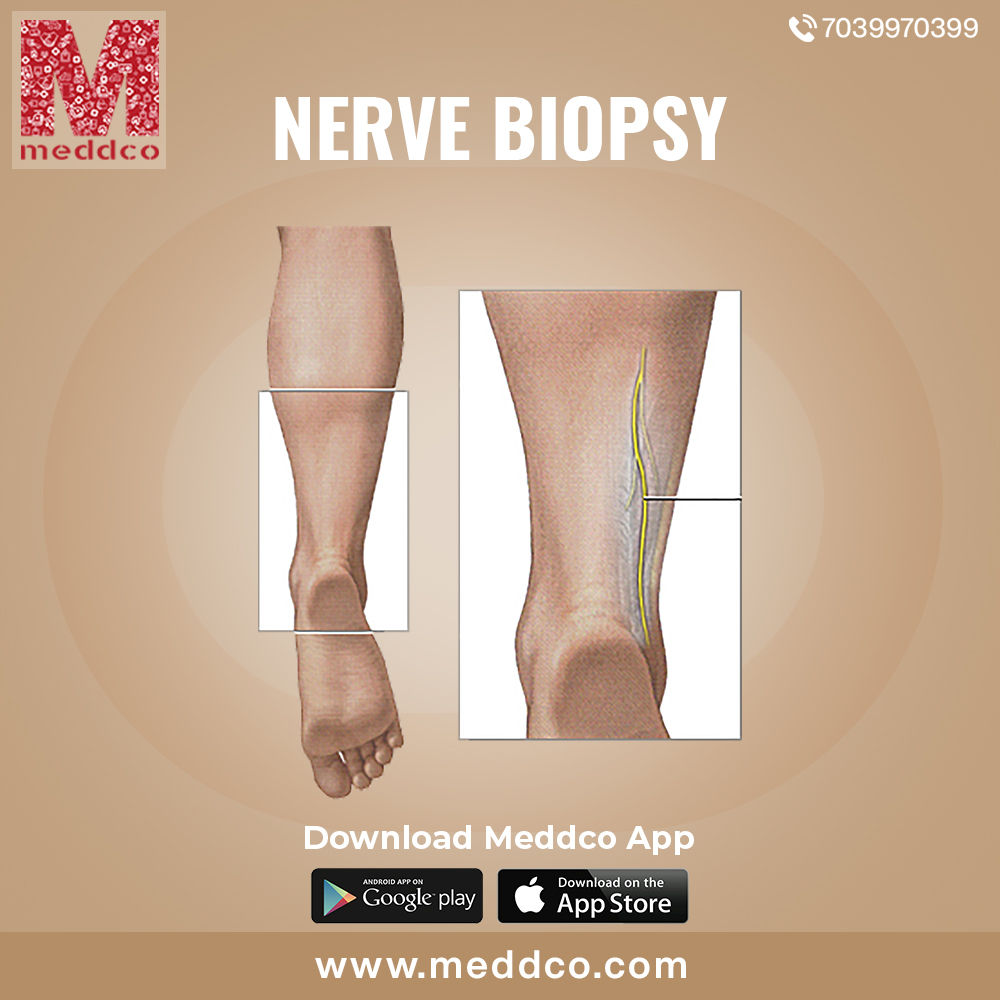 WHAT IS NERVE BIOPSY