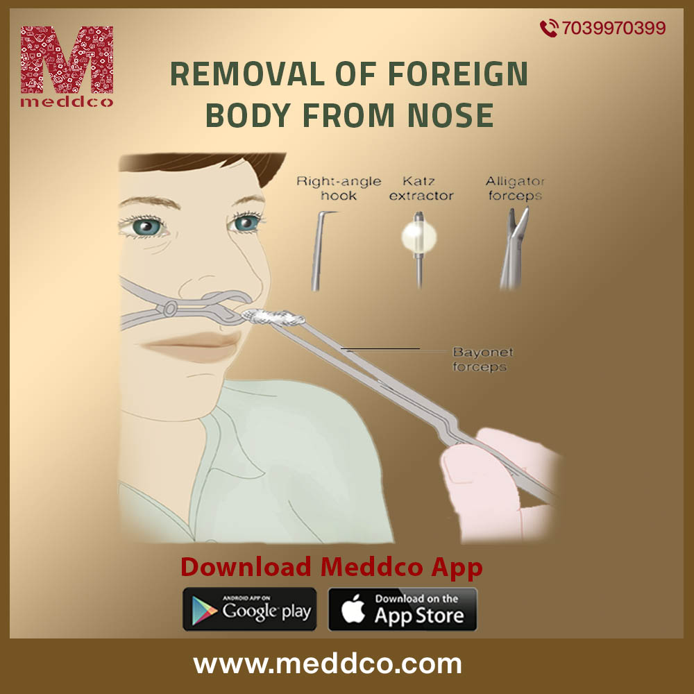 HOW IS  FOREIGN BODY REMOVED FROM NOSE?