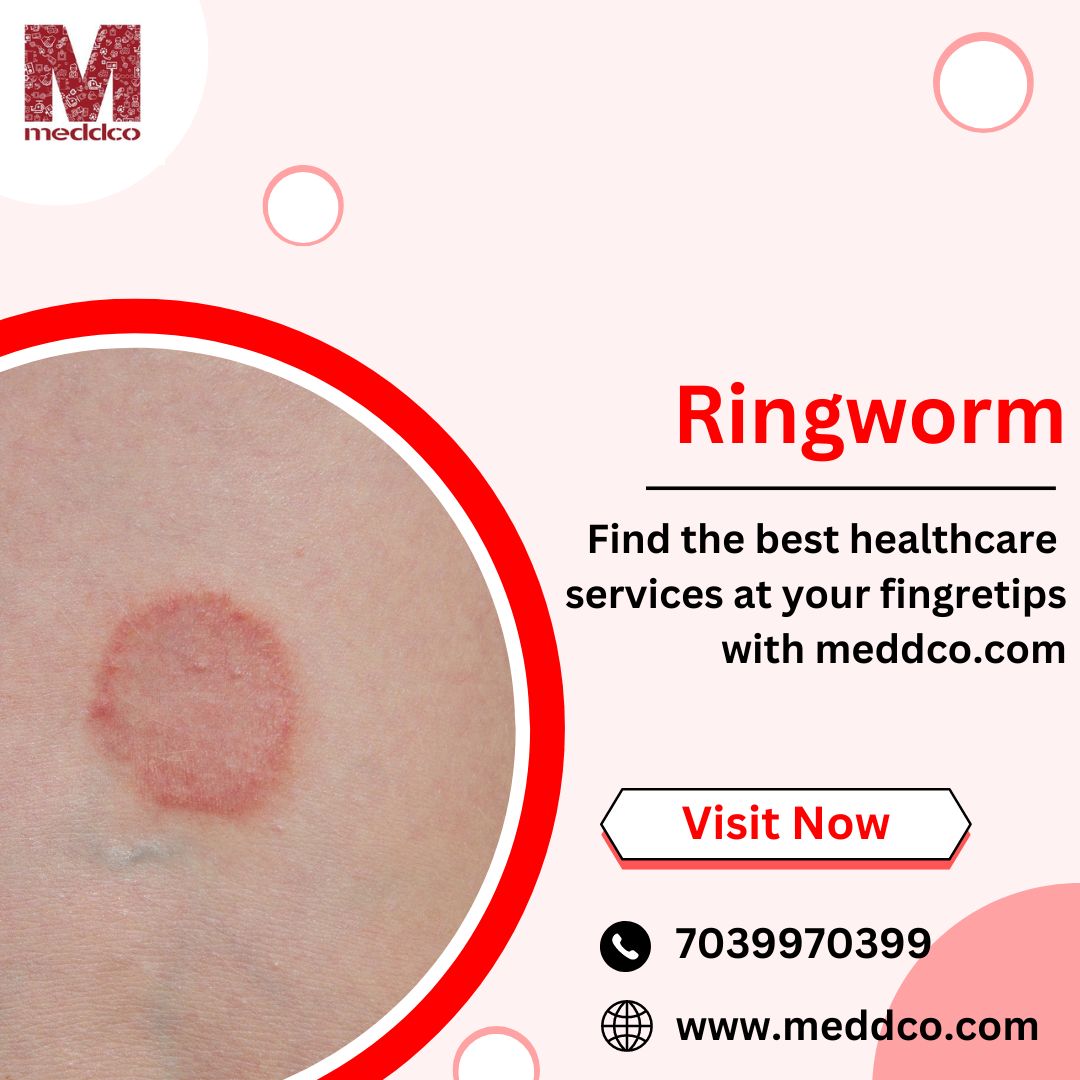 Ringworm in Pregnancy - Symptoms & Treatment