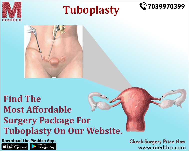 Tuboplasty Procedure for Blocked Fallopian Tubes
