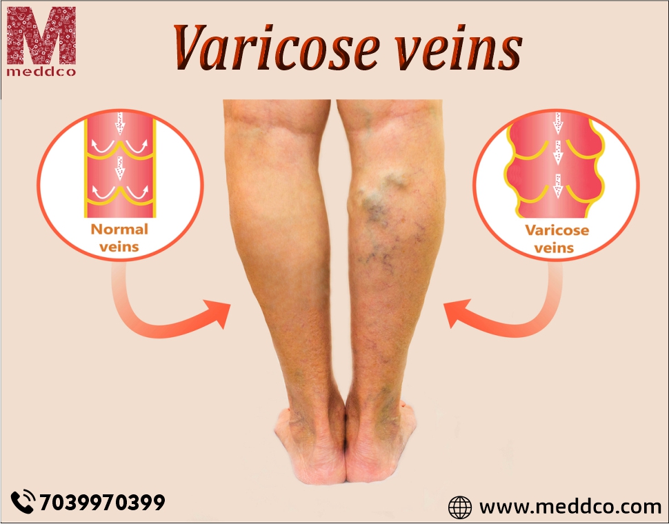 Say Good Bye to Varicose Veins